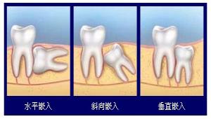 郑州哪家医院拔智齿好