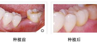 假牙的种类及价格